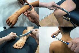 Instrument-Assisted Soft Tissue Mobilization (IASTM) - 1